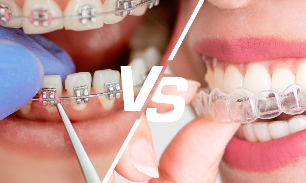Braces Vs Aligners