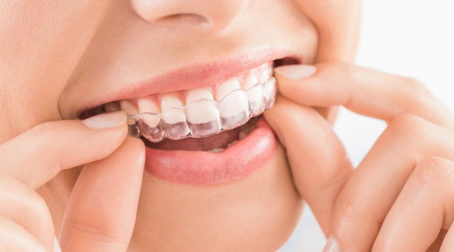 Invisalign Tips To Get Through Your Clear Aligner Journey – StarMintz